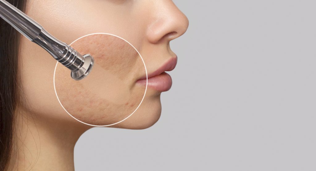 dermabrasion